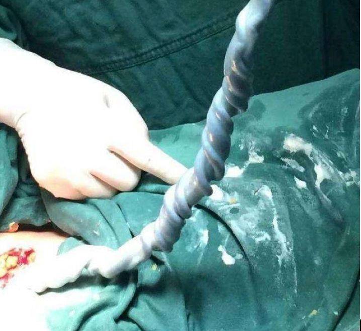 胎死腹中怎么超度-原来胎停育是有征兆的 胎死腹中怎么超度-原来胎停育是有征兆的