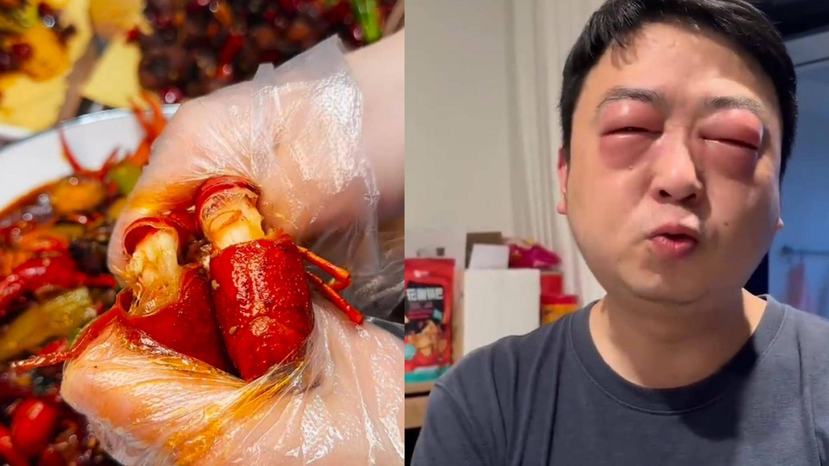男子吃小龙虾过敏双眼肿成"悲伤蛙"
