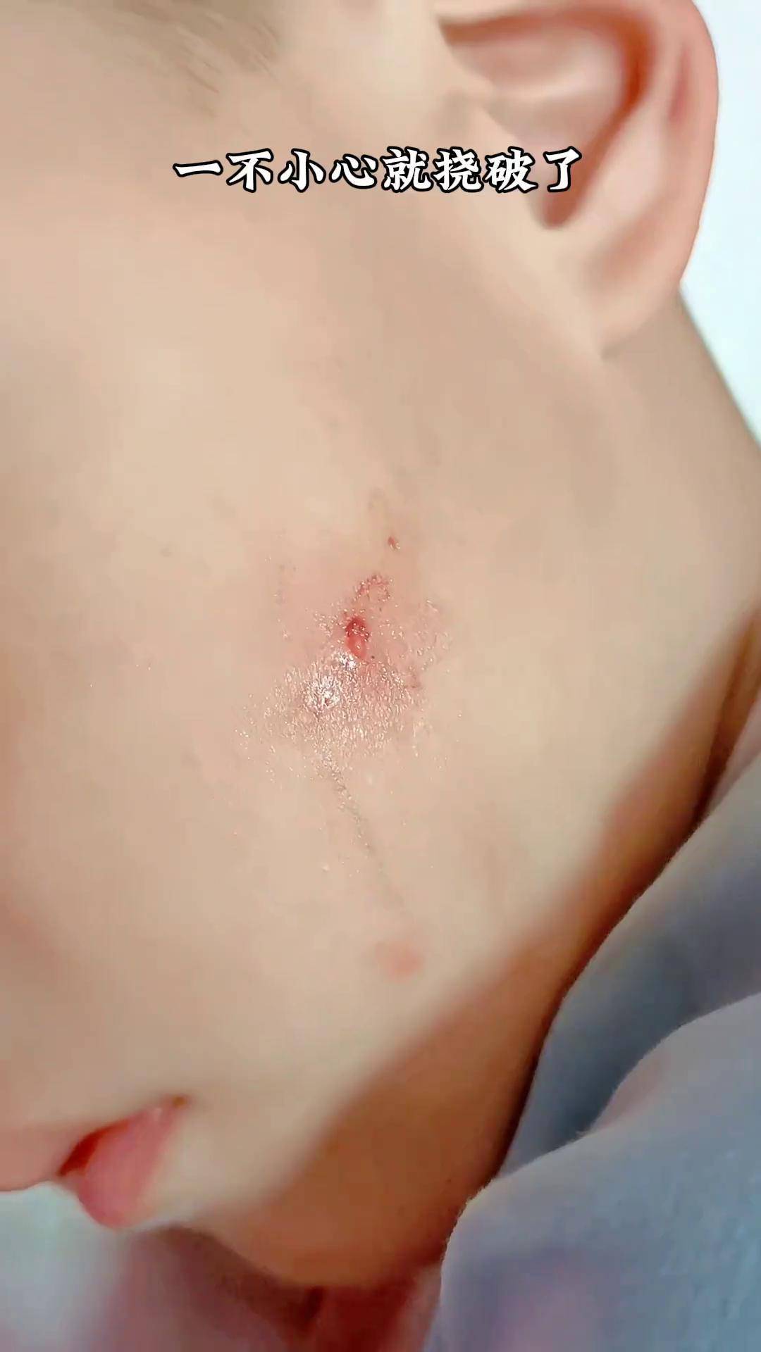 夏天最怕被蚊子咬了,一不小心就把脸挠破了