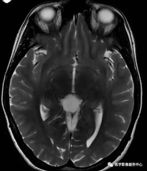 典型松果体区病变,过目不忘