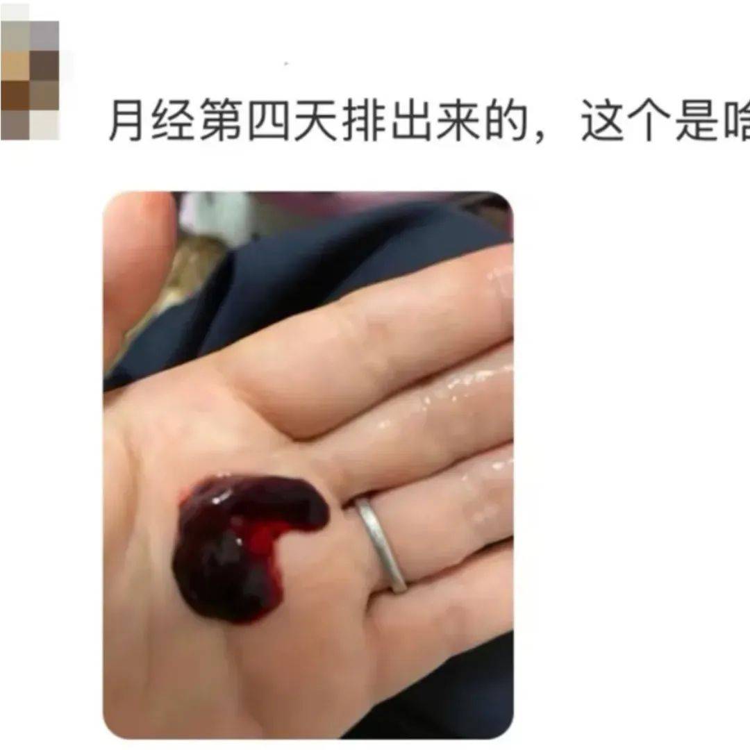 月经掉出超大血块，千万警惕 1 种情况