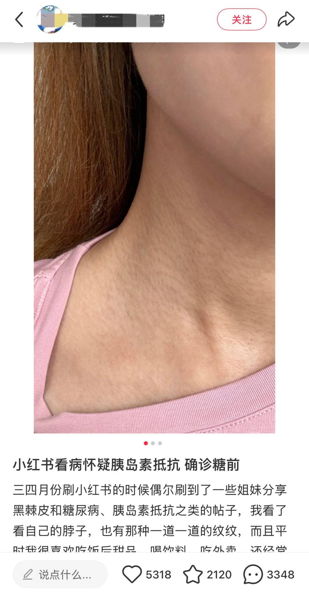 网友晒照求诊黑脖子是胰岛素抵抗专家不可靠