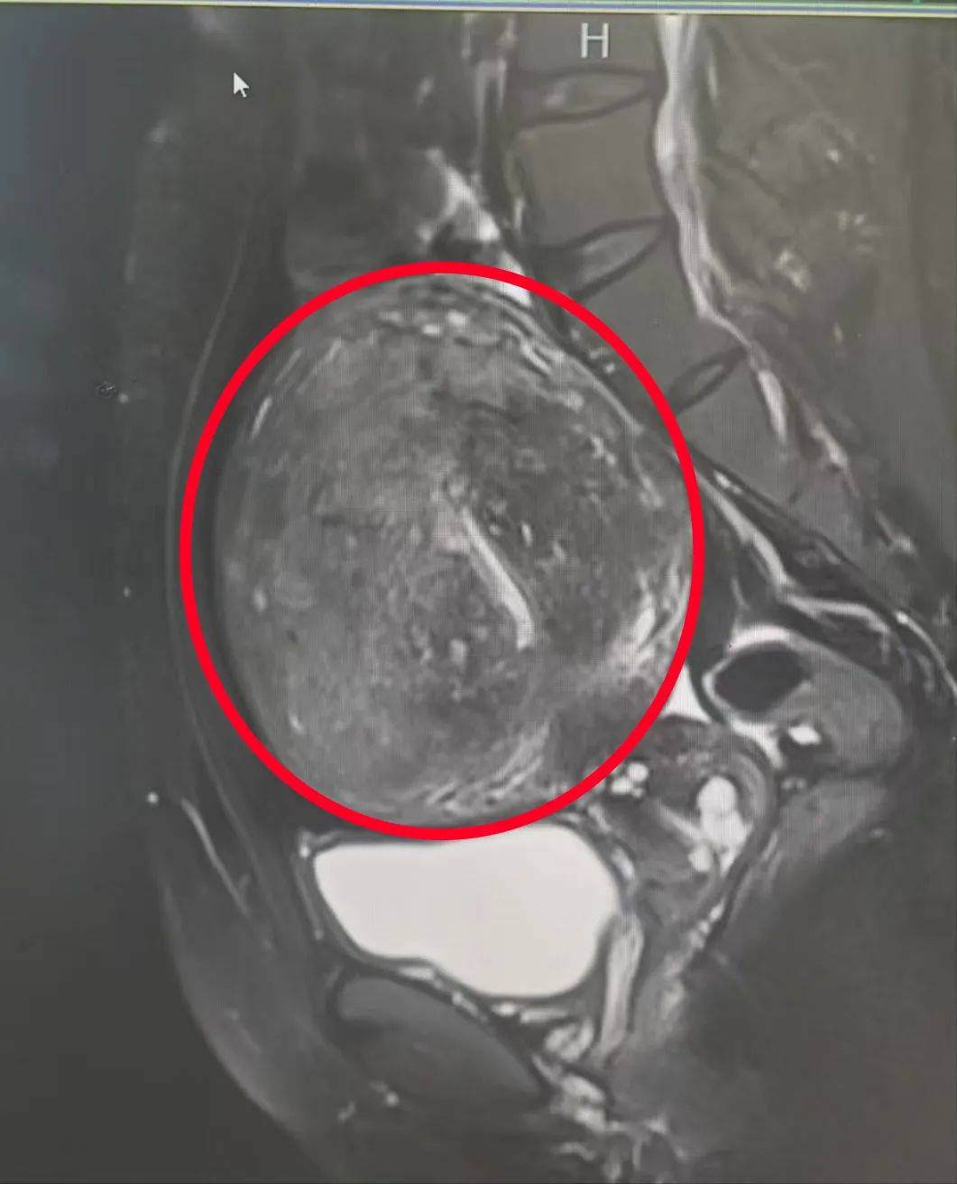 杭州市一医院产科好吗 痛经竟如生死劫？月经量多到贫血！子宫腺肌症作祟？微创技术终
