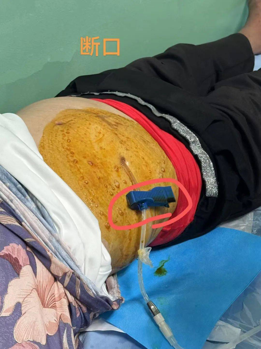 4厘米的生死距离!腹透管意外剪破 博白医护团队连夜奋战