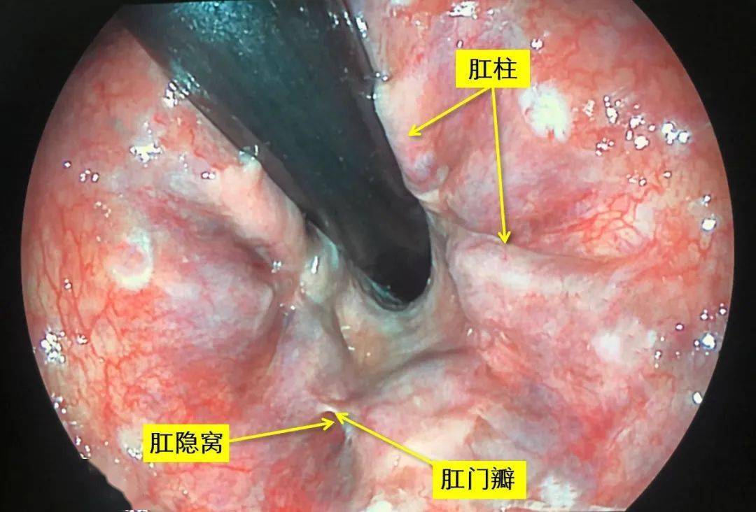 医学笔记︱肛周脓肿和肛瘘的"内口":为什么好发于截石位6点?