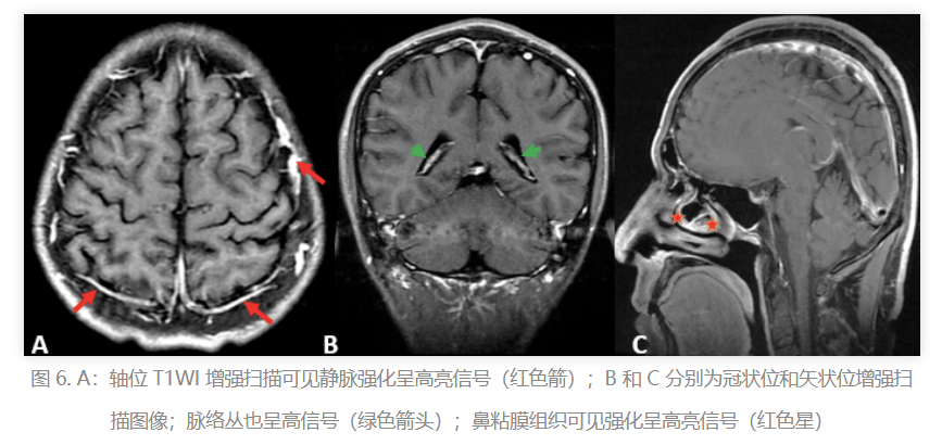 科普| 揭秘头颅磁共振,检查那么久,到底在查什么?