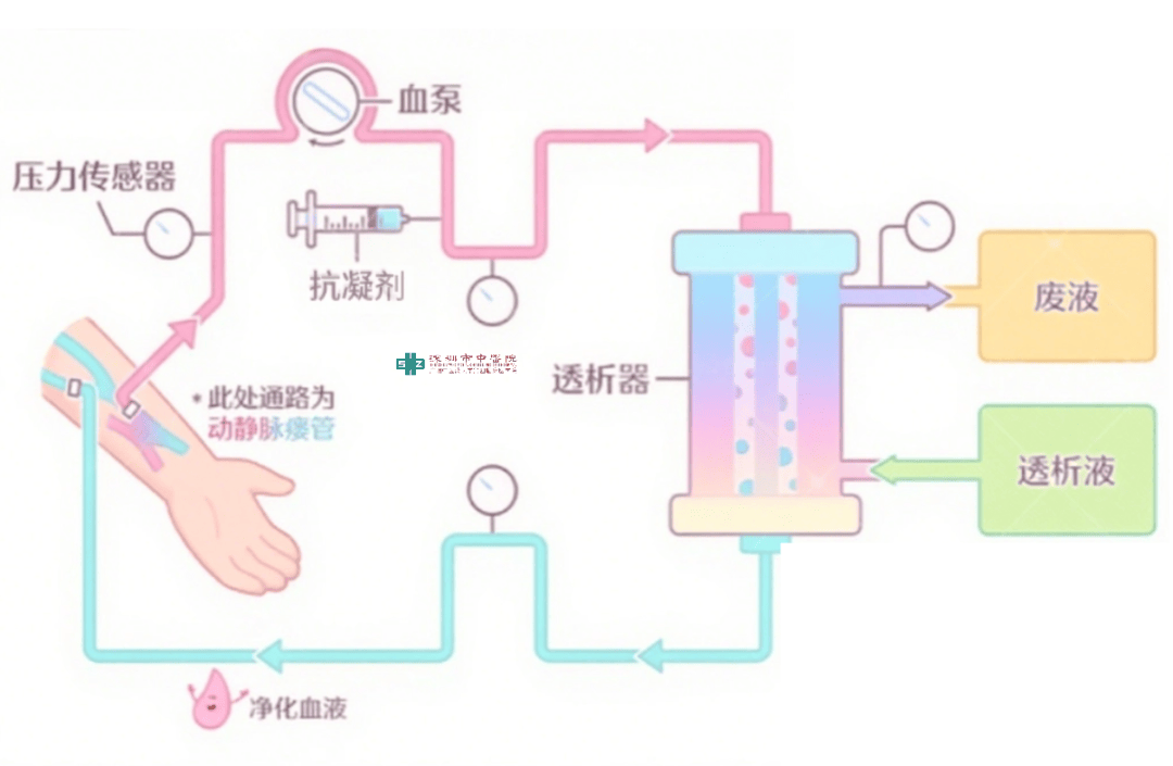 2透析器核心"人工肾",半透膜孔径大小决定清除哪些毒素