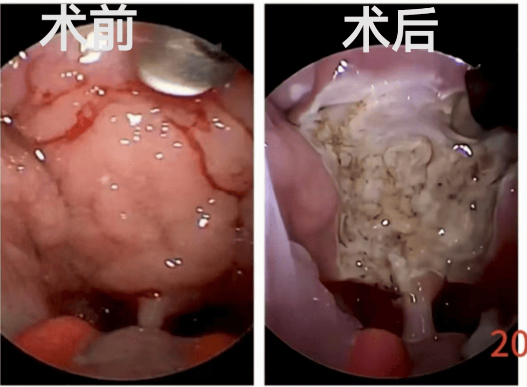 我院耳鼻咽喉头颈外科腺样体扁桃体手术视频获省赛第二名!