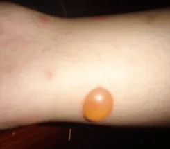 身体出现这5个症状，可能是血糖超标！