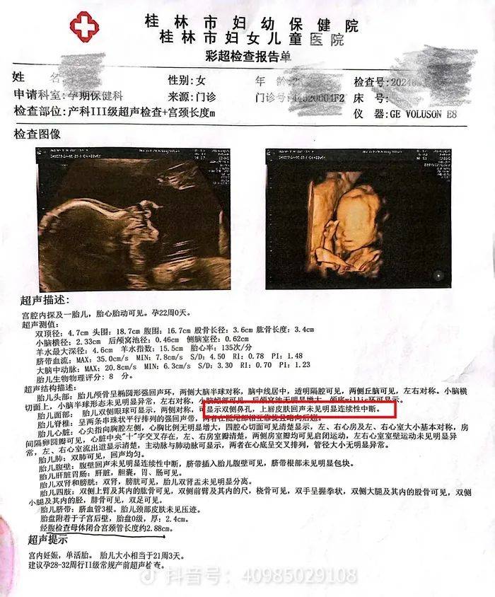 桂林女子称医院彩超漏诊婴儿唇腭裂，到卫生健康委反映问题遭呵斥，最新进展：工作人员停职检查，婴儿问题仍在处理