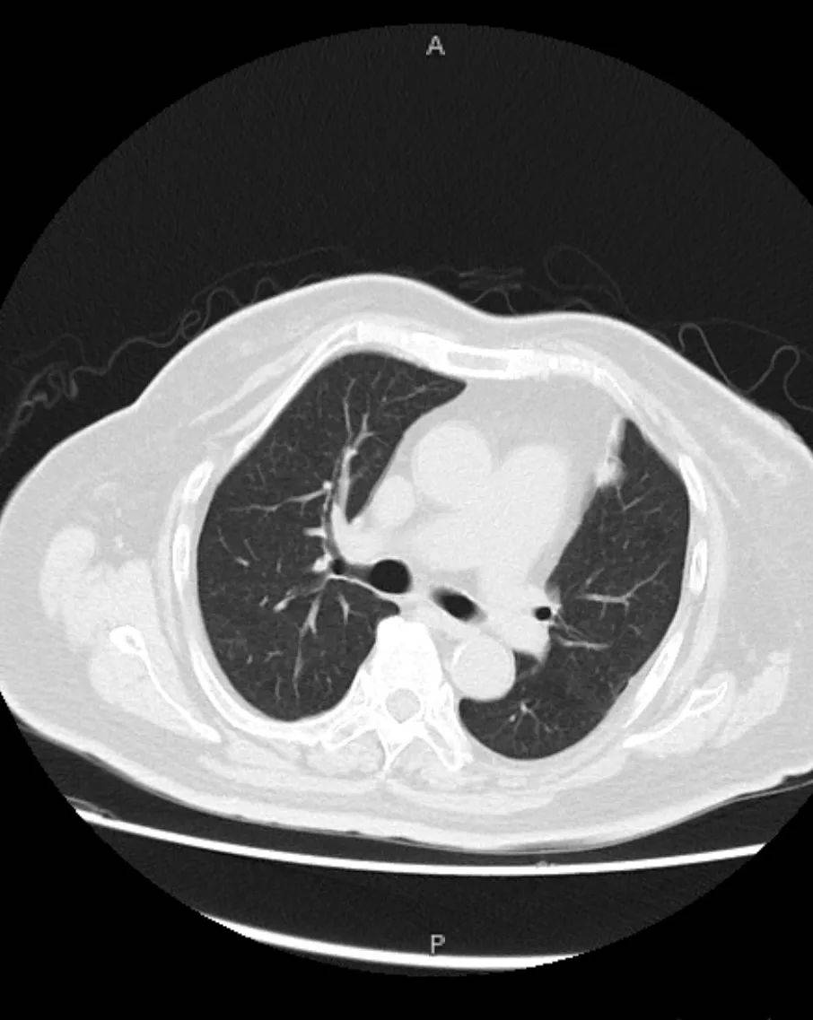 健康为民】淄博市中心医院东院肿瘤内科一病区成功开展ct引导下肺肿瘤