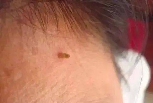 脖子上长出的小肉粒，能揪吗？
