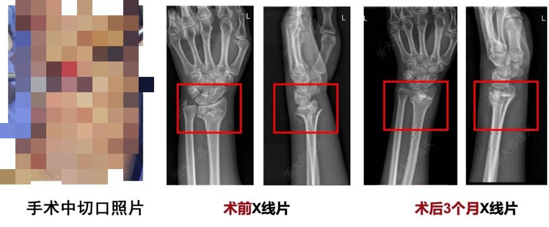 打一针就能治疗粉碎性骨折，浙大团队研发出全球首款“骨胶水”