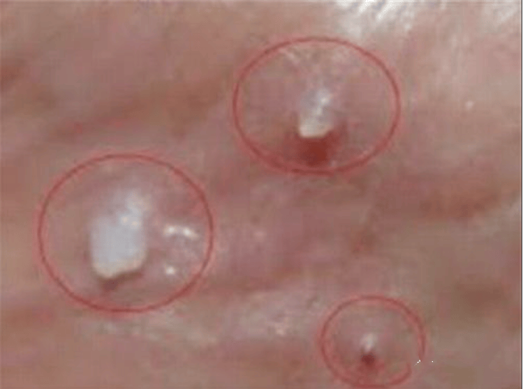 主要表现为鸡冠状或菜花状等赘状物,表面凹凸不平.1