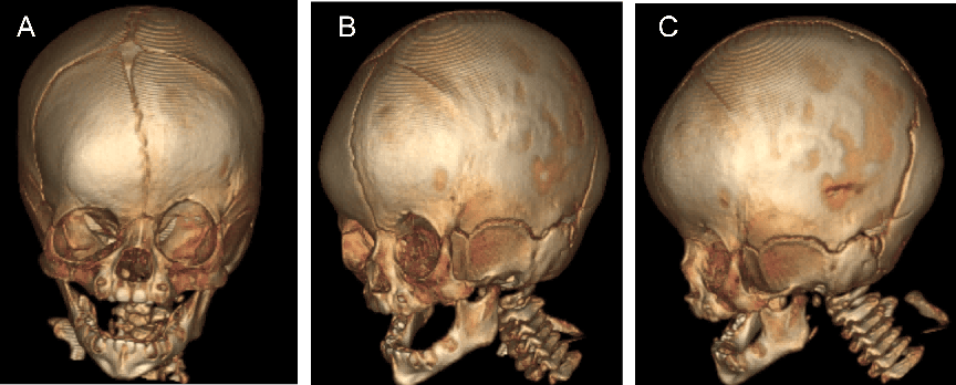 查体:头颅外观明显斜头畸形,左侧额部扁平,后缩,右侧额部代偿性隆起