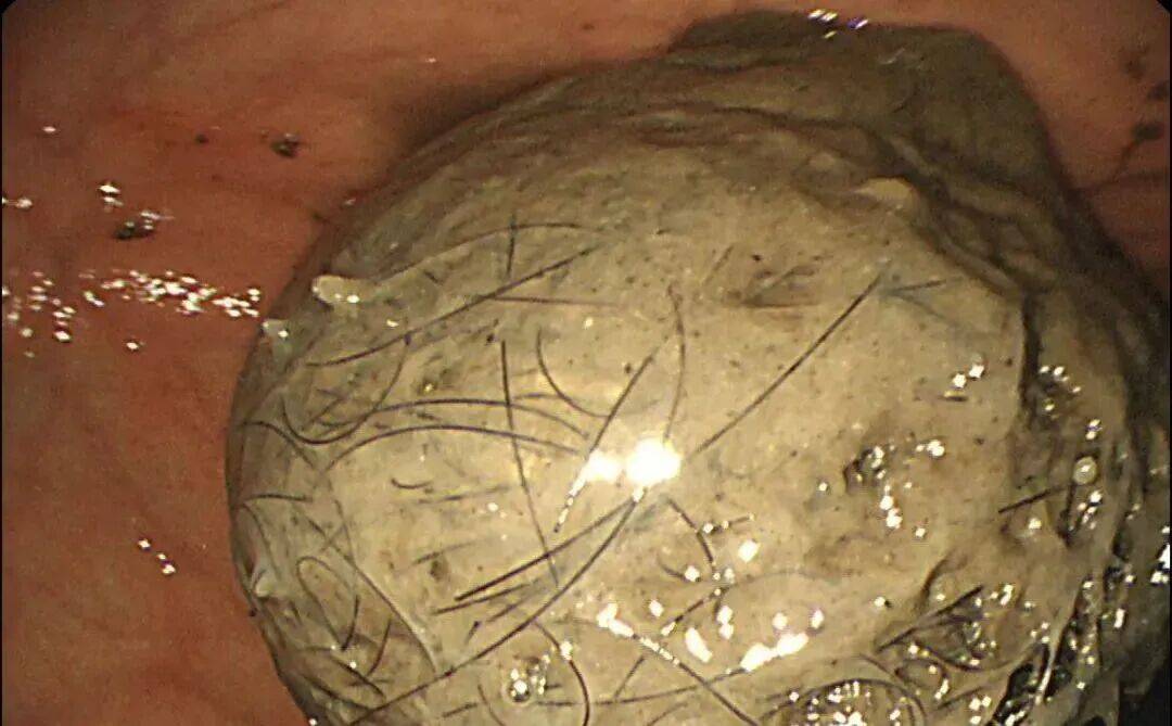 发现一例，10岁女孩确诊！已有多起病例，有人因羞耻感延误就医