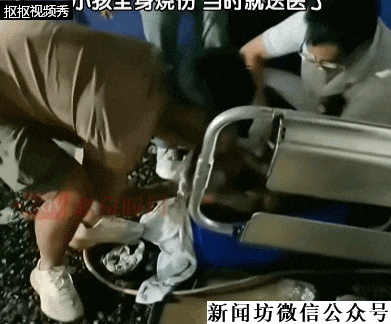 3岁男童掉进炭火堆全身85%烧伤