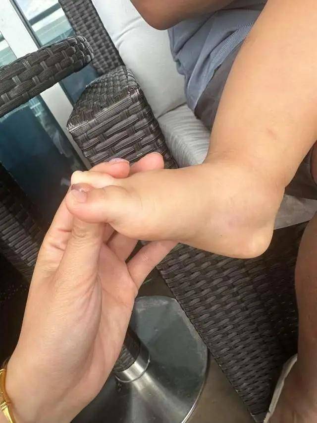 婆孙泳池边被毒虫咬伤，追责维权陷僵局；五星酒店：自然环境中蚊虫不可避免