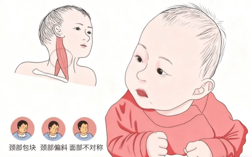 儿童肌性斜颈别拖延!重庆仁品医院中医调理改善头颈歪斜
