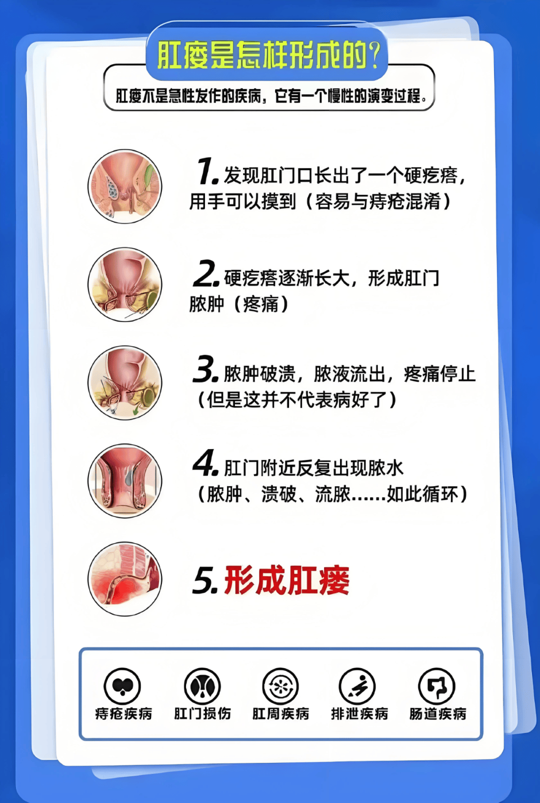 【科普】虚实挂线术治疗高位肛瘘_肛门_直肠_手术