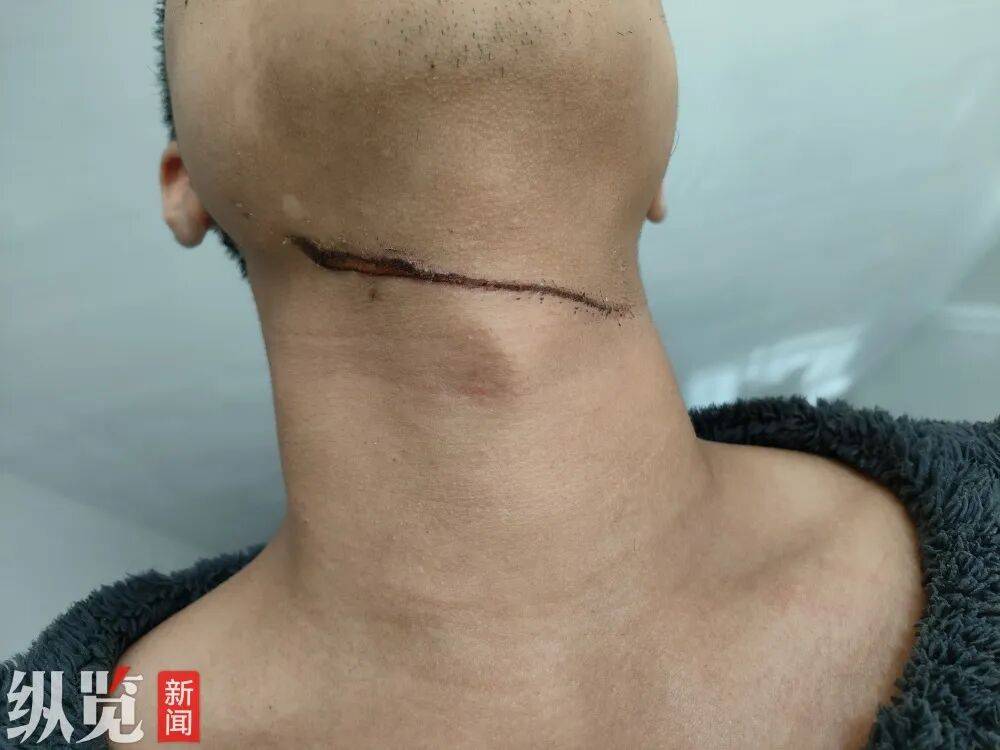 “一摸满手是血”！男子夜骑遭晾衣绳“割喉”，勒痕长达10厘米左右，物业：事发监控盲区，尚未找到拴绳人