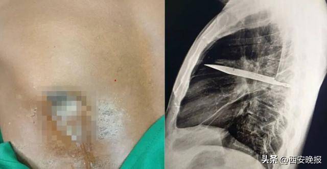 罕见！坦桑尼亚44岁男子胸口流脓发出恶臭，照X光才发现有把刀在体内长达8年，刚好避开心脏血管