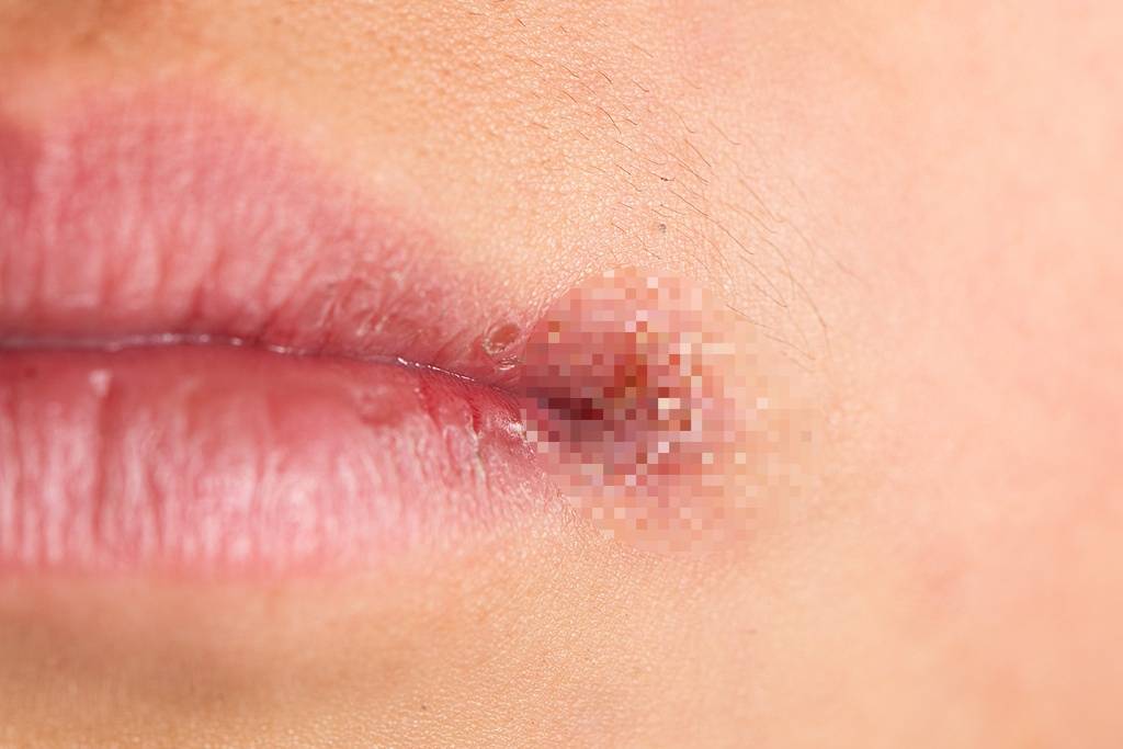 嘴角长了小水泡后，竟脑死亡！医生：不是简单的上火