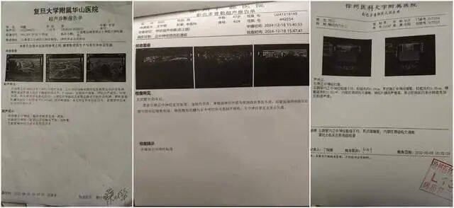 男子骨折手术数月后右手正中神经受损 病历被医院修改30次(图3)