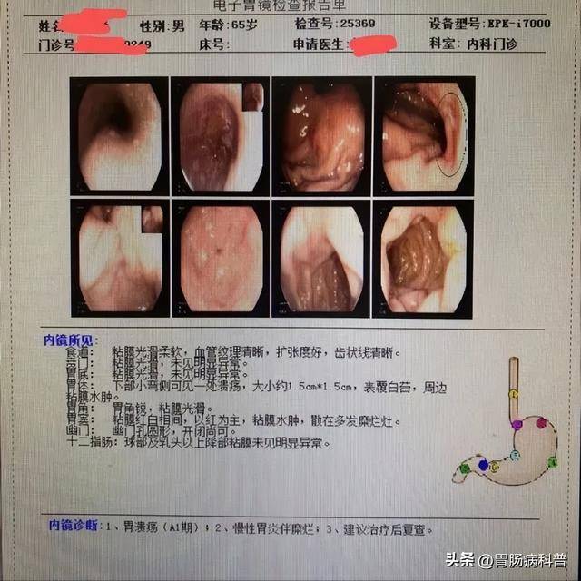 小小胃溃疡，半年后变胃癌！这个真实教训太深刻了！