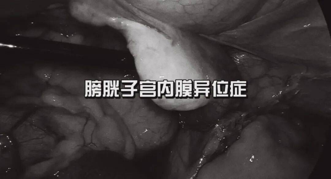 “迷路”的子宫内膜：当它“跑”进膀胱和输尿管，该怎么办？