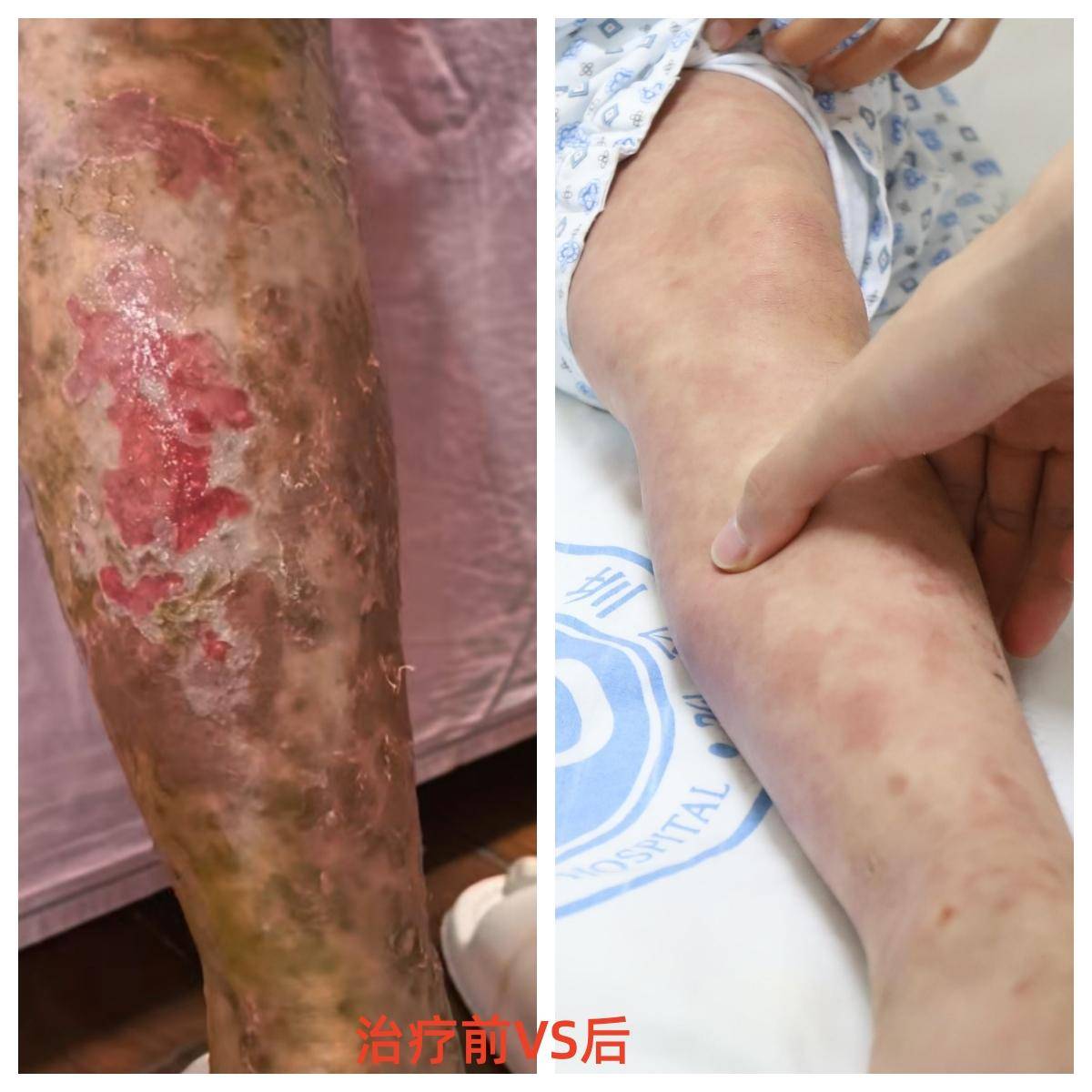 家长轻信“排毒”给孩子药浴三个月，致7岁女儿八成皮肤溃烂